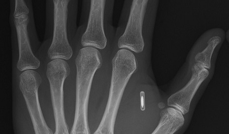 X-Ray of Tobias Degsell's hand